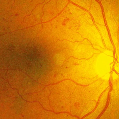 wichita diabetic retinopathy