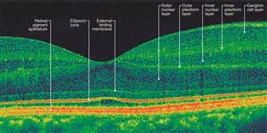 Retina Scan May Give Early Warning of Alzheimer’s Disease